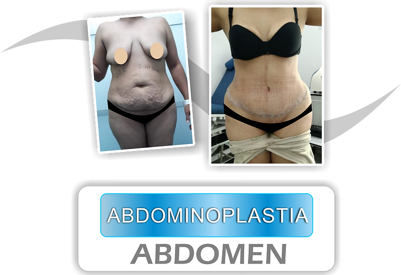 ABDOMINOPLASTIA CON FOTO.png