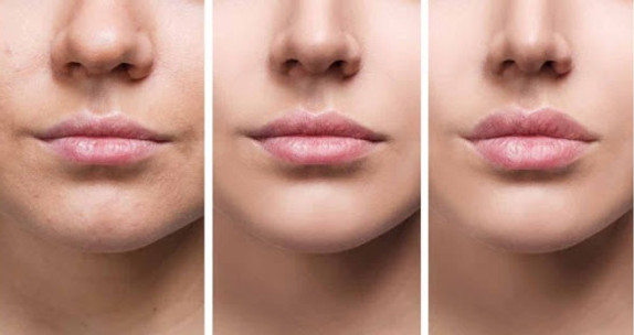 rejuvenecimiento de labios.jpg