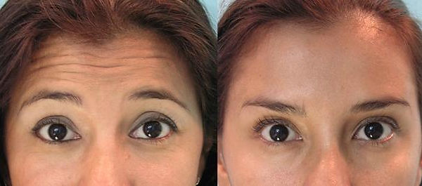botox.jpg
