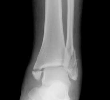 Bimalleolar vs. Trimalleolar vs. Lateral Malleolus Fractures Explained