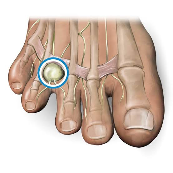 Morton's Neuroma