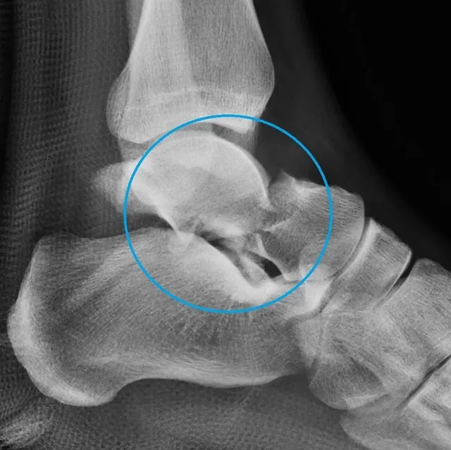 talus fracture