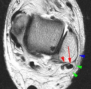 Peroneal Tendon Tear MRI: What It Shows and When You Need One