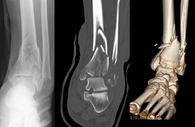 Pilon Fracture: Distal Tibia Fracture Surgery and Recovery