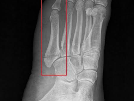 Does a Fifth Metatarsal Fracture Need Surgery?