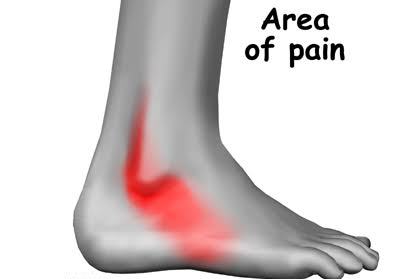 area of ankle pain peroneal injury