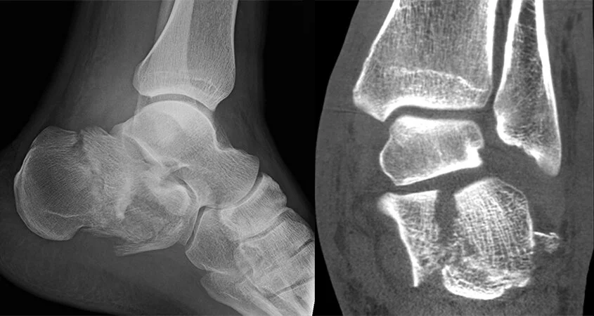 Calcaneus Fracture: When Does a Broken Heel Need Surgery?