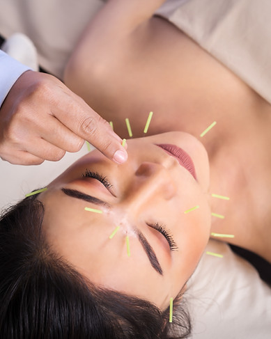 Facial Acupuncture | Facial Acupuncture