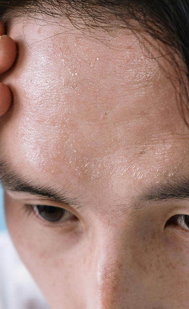 botox for sweating sydney