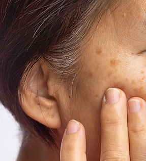 skin pigmentation.png