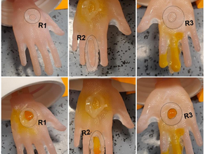 Cutting-Edge Technology in Dermatology: The Impact of 3D Printing on Skin Grafts