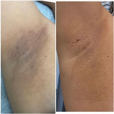 anal bleaching lightening treatment