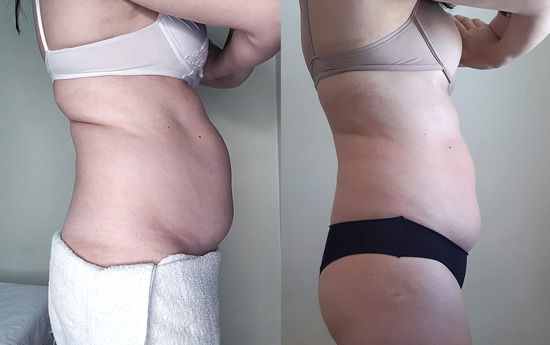 resultatado-procedimento-massagens-massagem-jess-corporal-porto-alegre-clinica.jpg