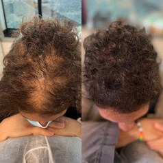 Edge Scalp Ink | Scalp Micropigmentation | SMP | Women's Hair Density | Bethesda, Maryland