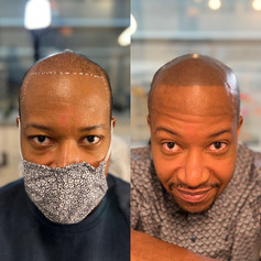 Edge Scalp Ink | Scalp Micropigmentation | SMP | Men's Hair Density and Hairline Design | Bethesda, Maryland