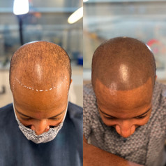 Edge Scalp Ink | Scalp Micropigmentation | SMP | Men's Hair Density and Hairline Design | Bethesda, Maryland