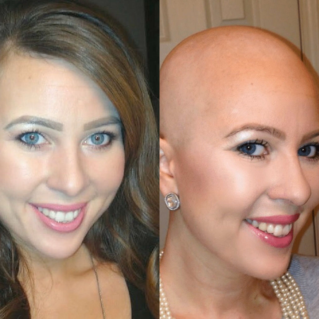Cancer Hair Loss Support CancerPal