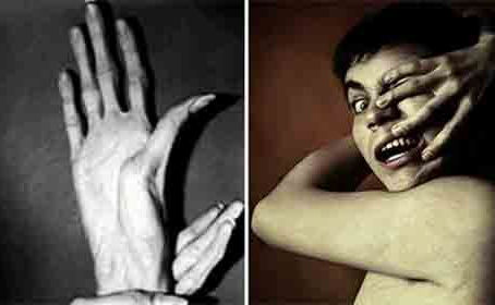 ELİMDEKİ YABANCI: ALINE HAND SYNDROME
