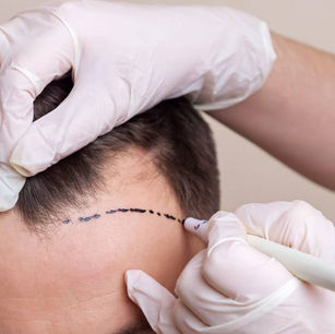 Pourquoi perd-on ses cheveux ?