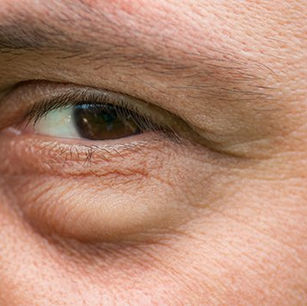 Comment enlever les poches sous les yeux ?