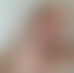 J'ai testé la mésothérapie avec Meso-Glow, mon avis