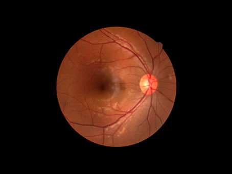 Entendendo a retinopatia diabética: um guia para saúde dos olhos