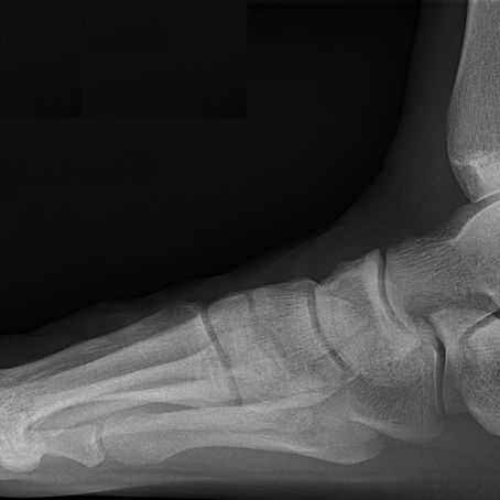 Why does an ankle mobilisation work so well?
