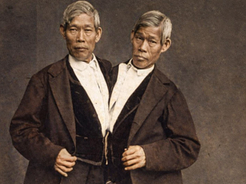 Entenda por que nascem gêmeos siameses e quais os desafios dessa condição.