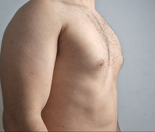Pectus excavatum correção sem cirurgia.jpg