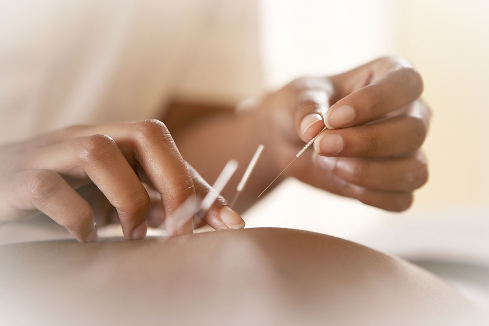 Acupuncture Therapy_edited.jpg