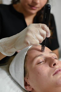 My Bare Skin | Microneedling