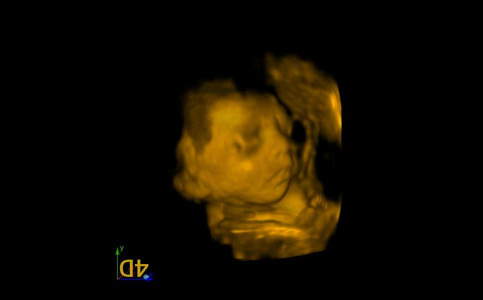 3D Ultrasound Picture