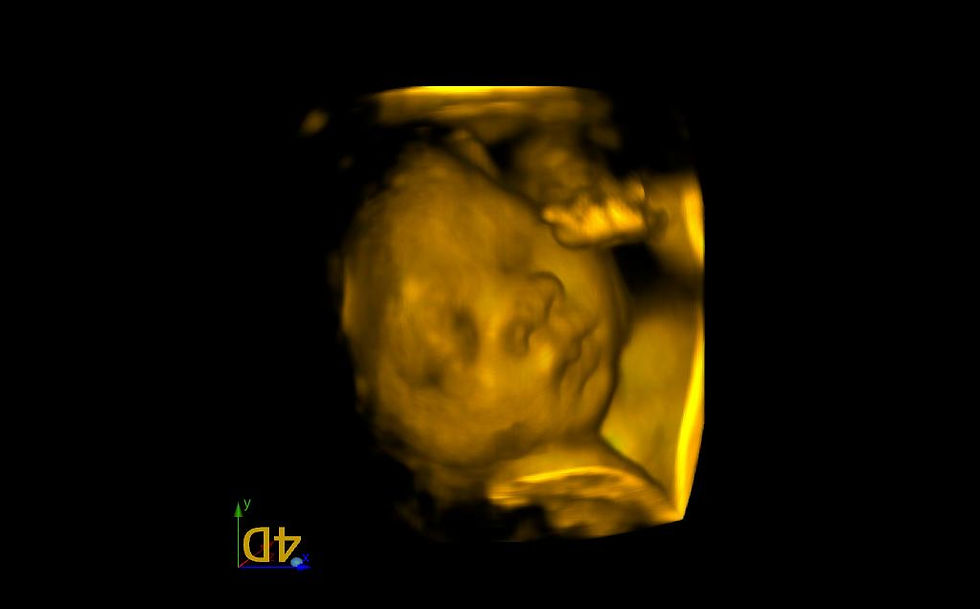 3D Ultrasound Picture