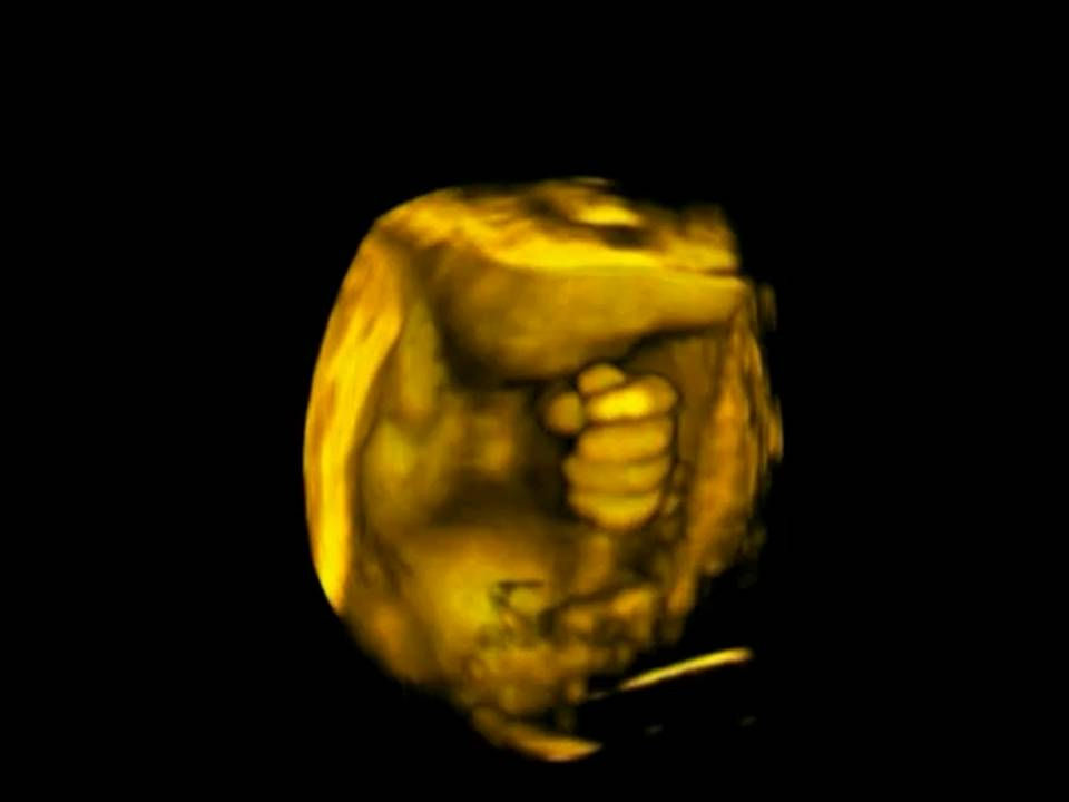 3D Ultrasound Picture
