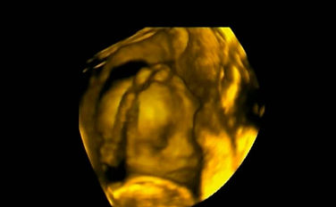 3D Baby Ultrasound