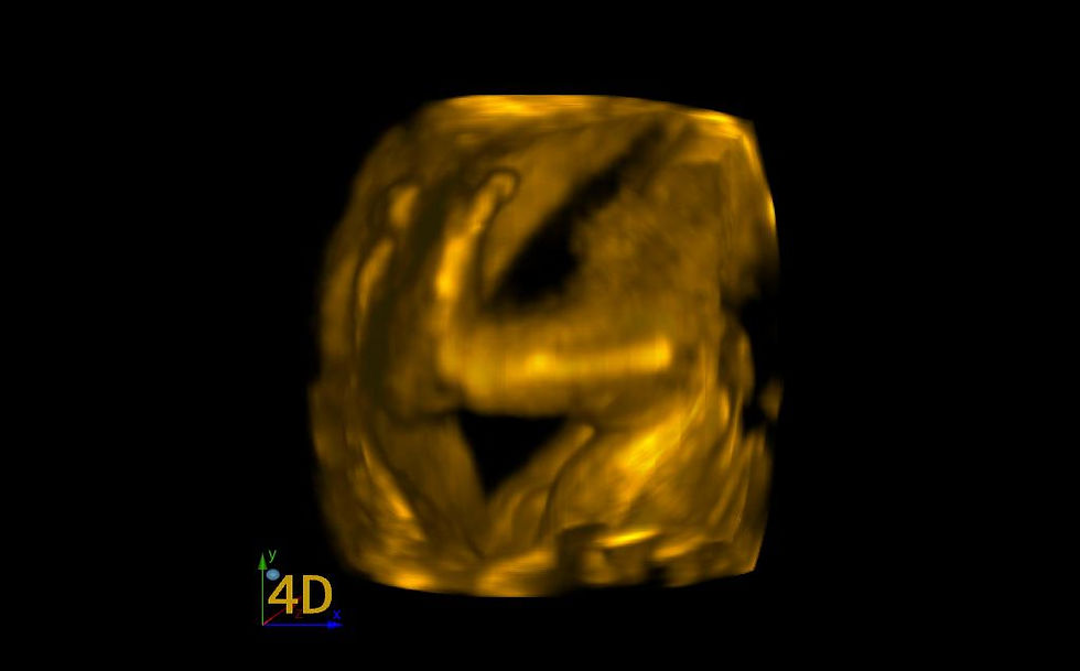 3D Ultrasound Picture