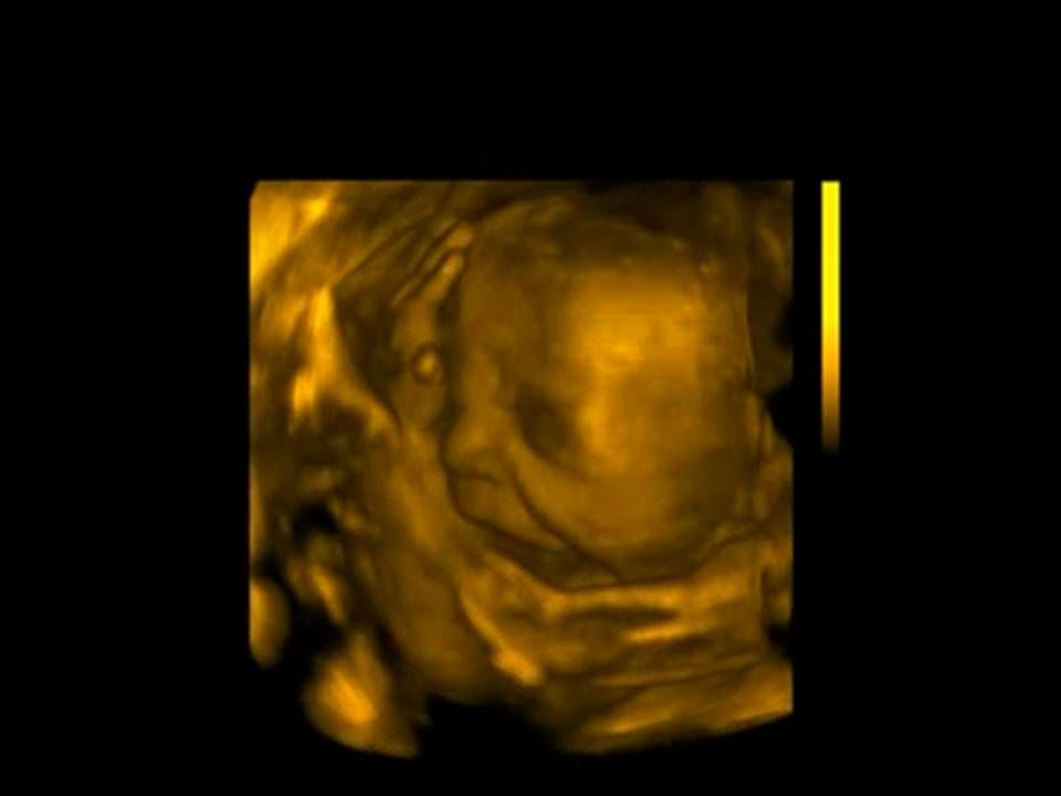 3D Ultrasound Picture