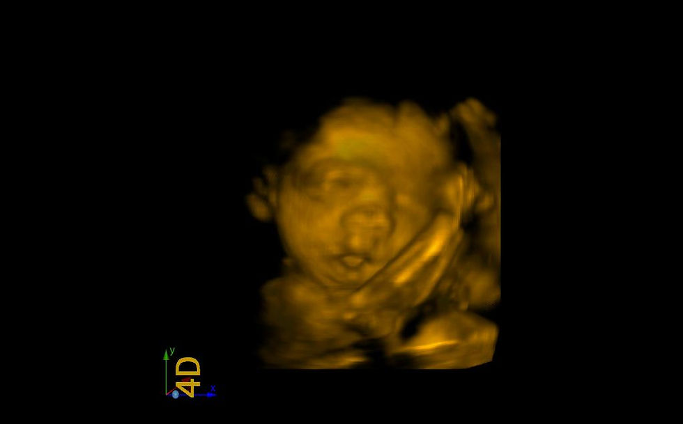 3D Ultrasound Picture
