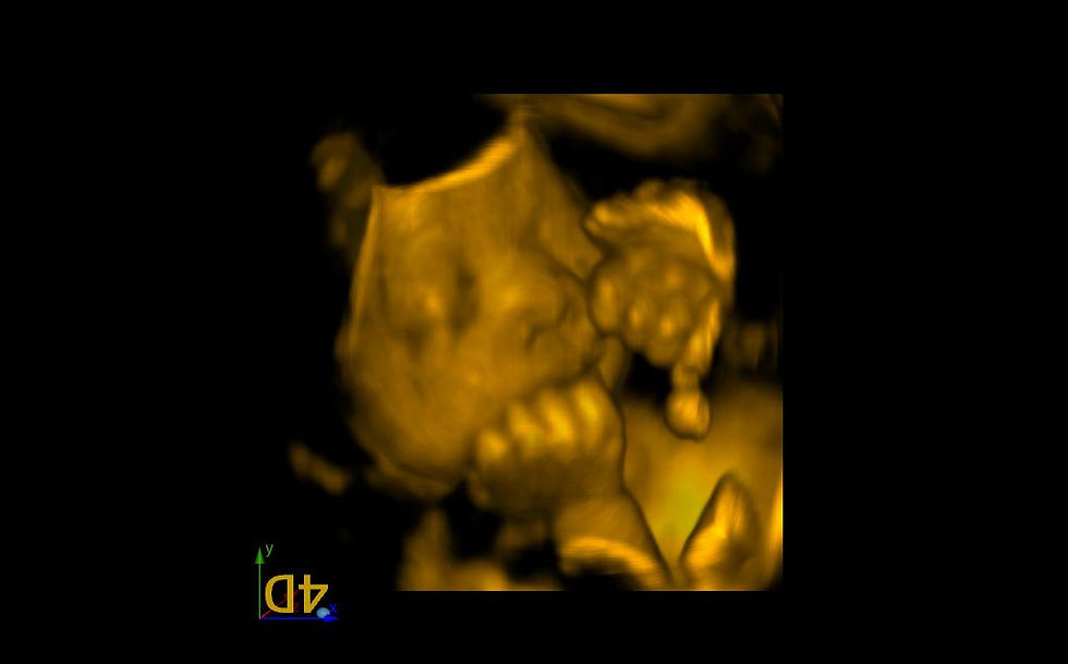 3D Ultrasound Picture