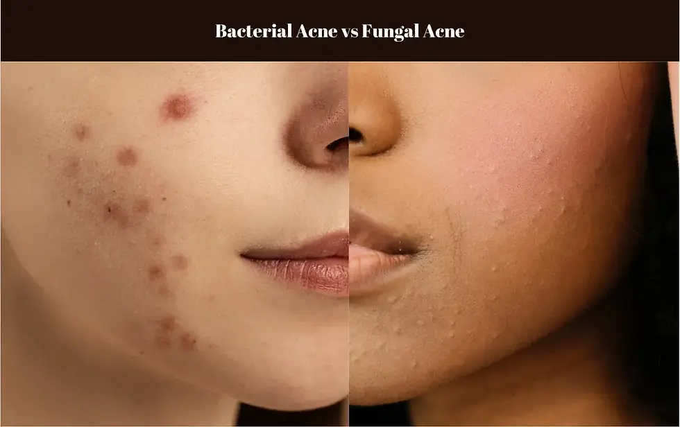 Fungal Acne Vs Bacterial Acne Identifying And Treating Different Acne fungal-acne-vs-bacterial-acne-identifying-and-treating-different-acne
