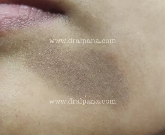 Lichen Planus Pigmentosus appearance near lower lip