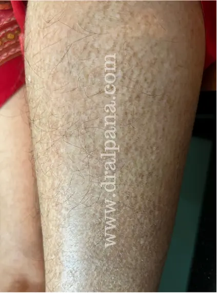 Clinical image macular amyloidosis on leg