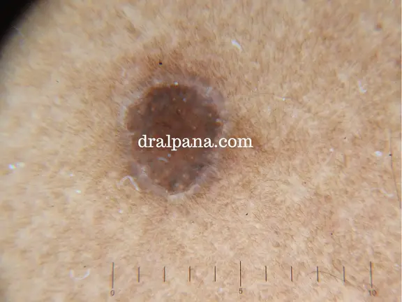 Classical lesion of porokeratosis showing thready border as seen under a dermatoscope