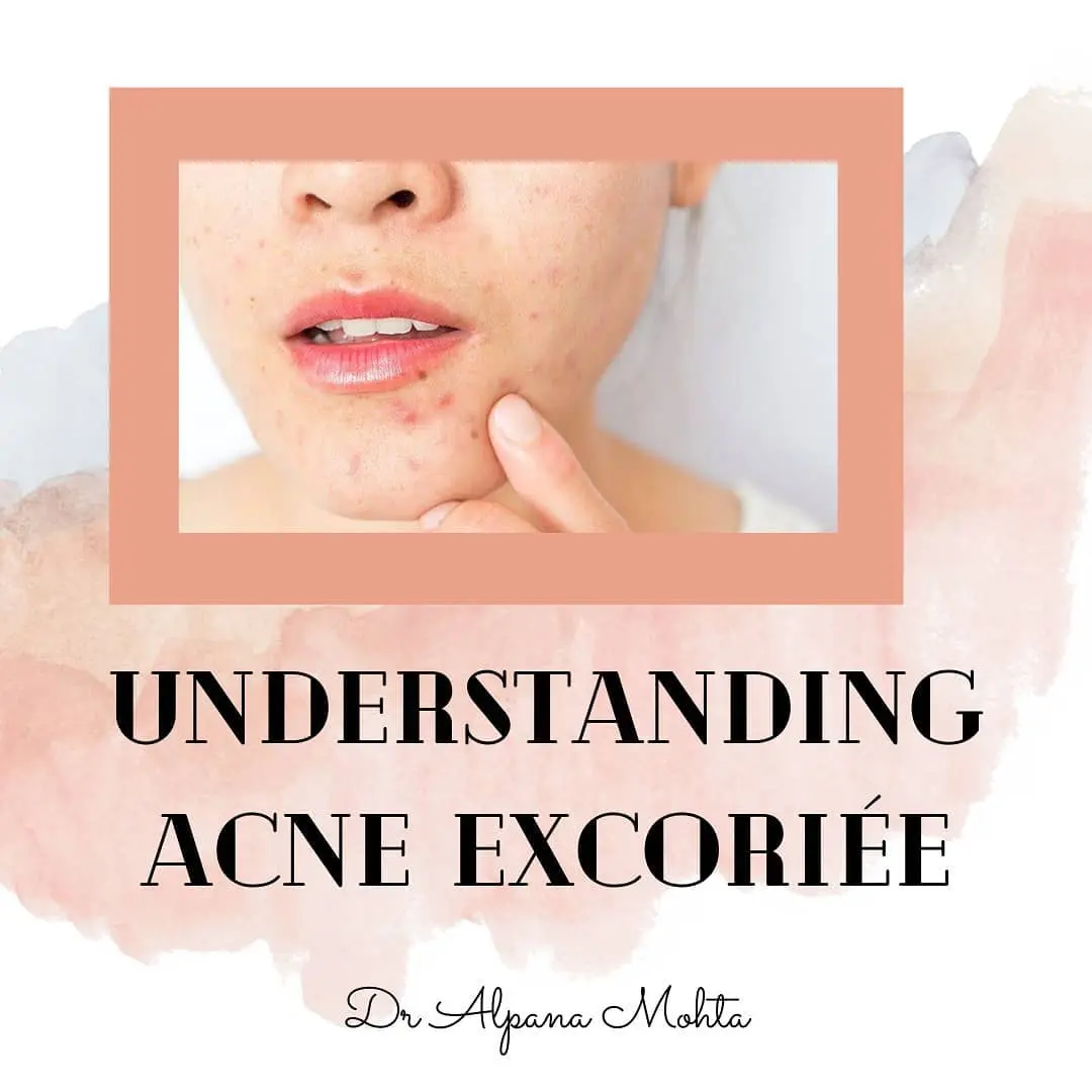 Acne induced dark spots on a woman's face with her picking at them