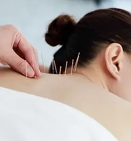 Treating with Acupuncture.jpeg.webp
