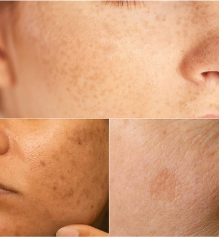 Tache-Brune_Pigmentaire-lentigos-Melasma.png
