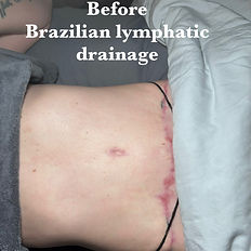 Before Brazilian Lymphatic Drainage