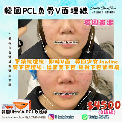 韓國PCL魚骨V面埋線_3.jpg