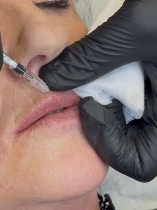Lip Filler Treatment 