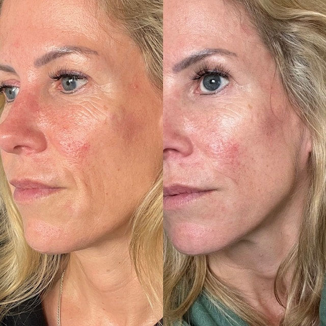 Skin Booster Before and After
